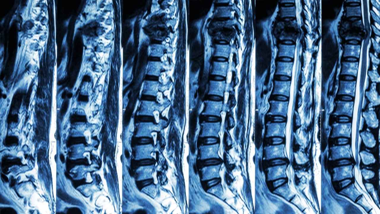 Waterbury Spinal Cord Injury Attorney