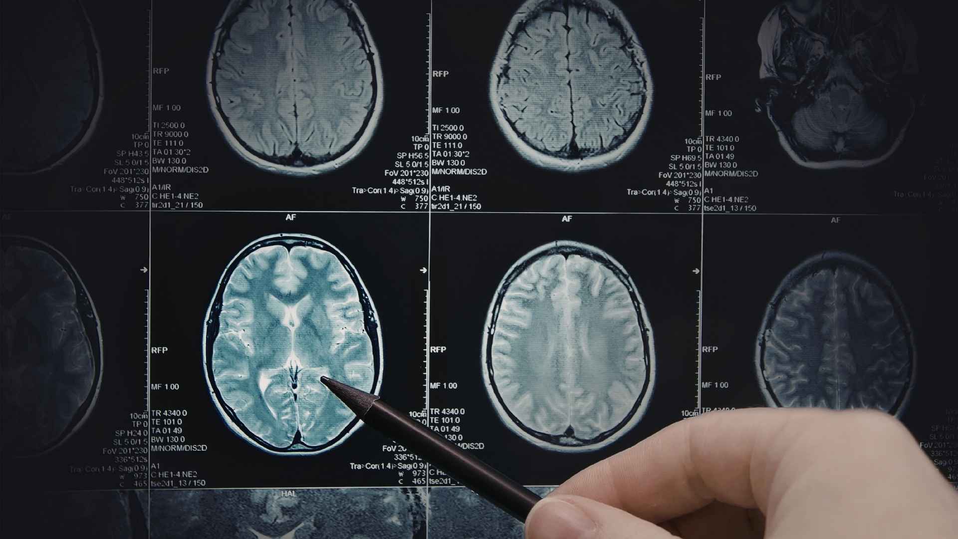Hempstead Traumatic Brain Injury Attorney