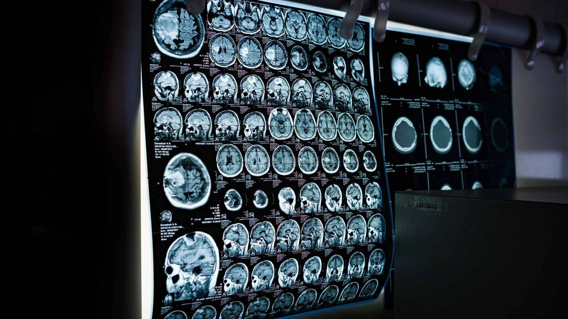 Springfield Traumatic Brain Injury Attorney